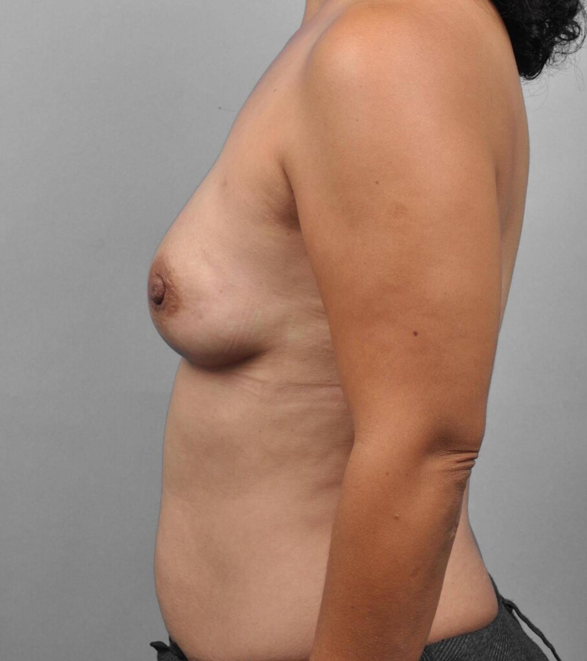 Case 1290 — Oblique after