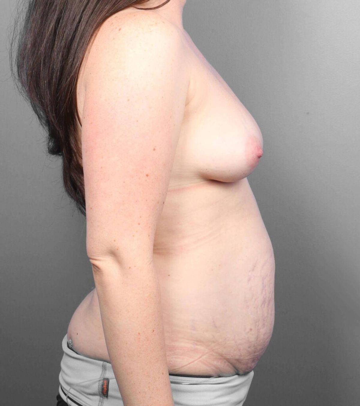 Case 1697 — Oblique before