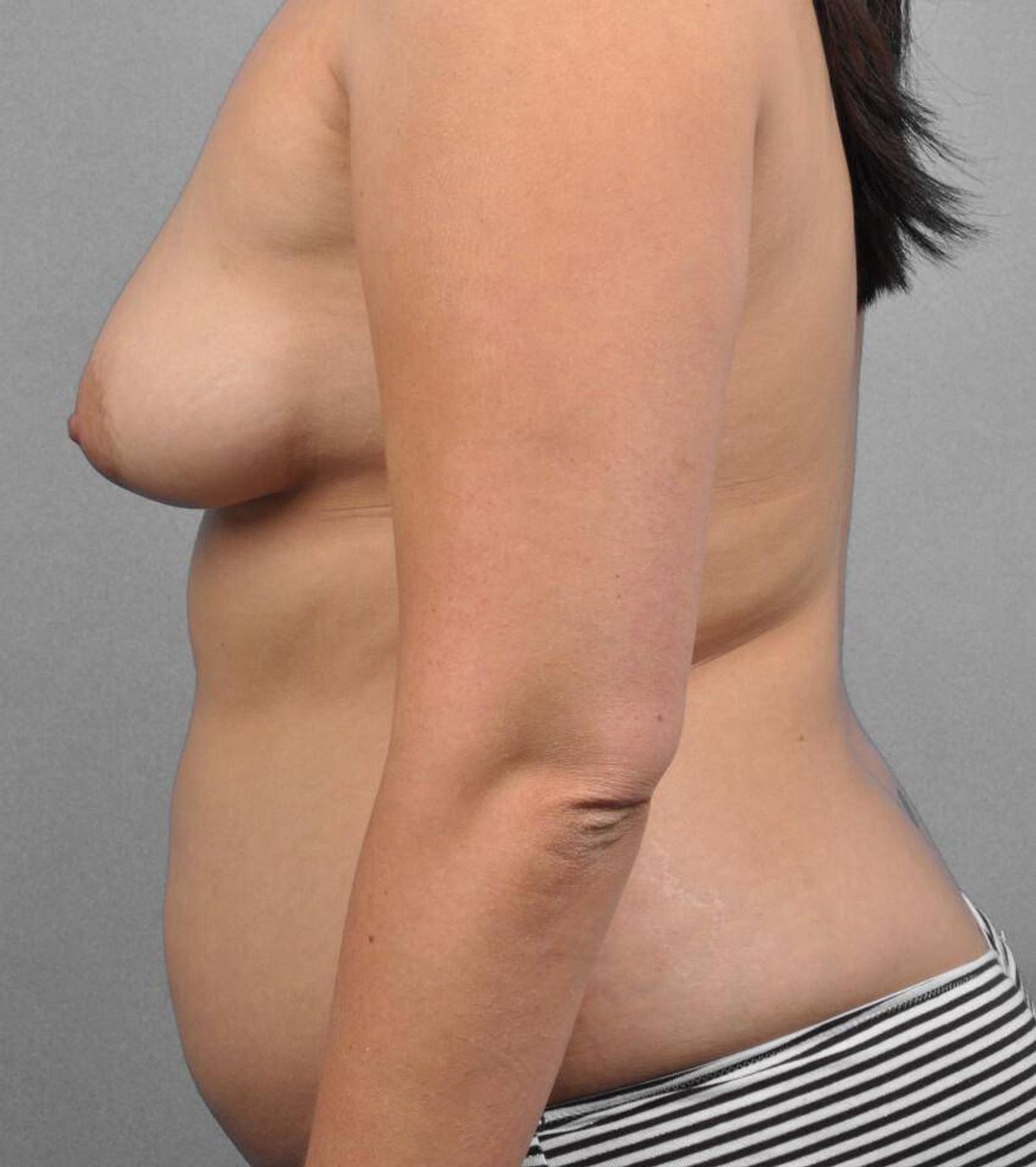 Case 1565 — Oblique before