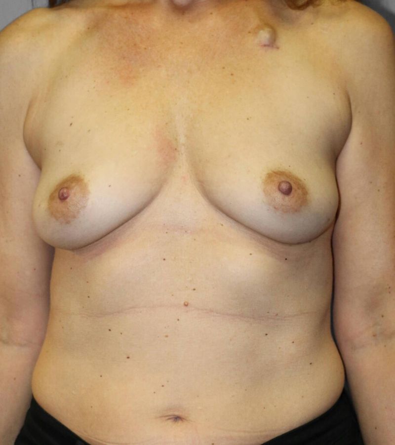 Before — Direct-to-Implant Reconstruction