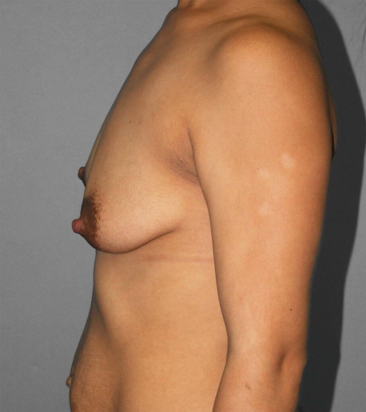 Case 1560 — Oblique before