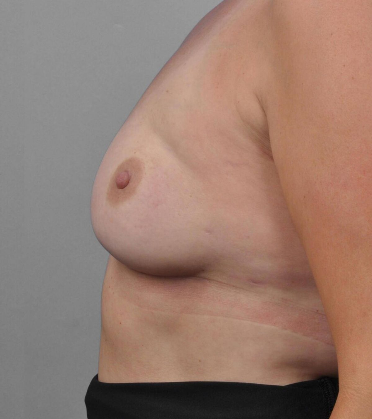 Case 1358 — Oblique after