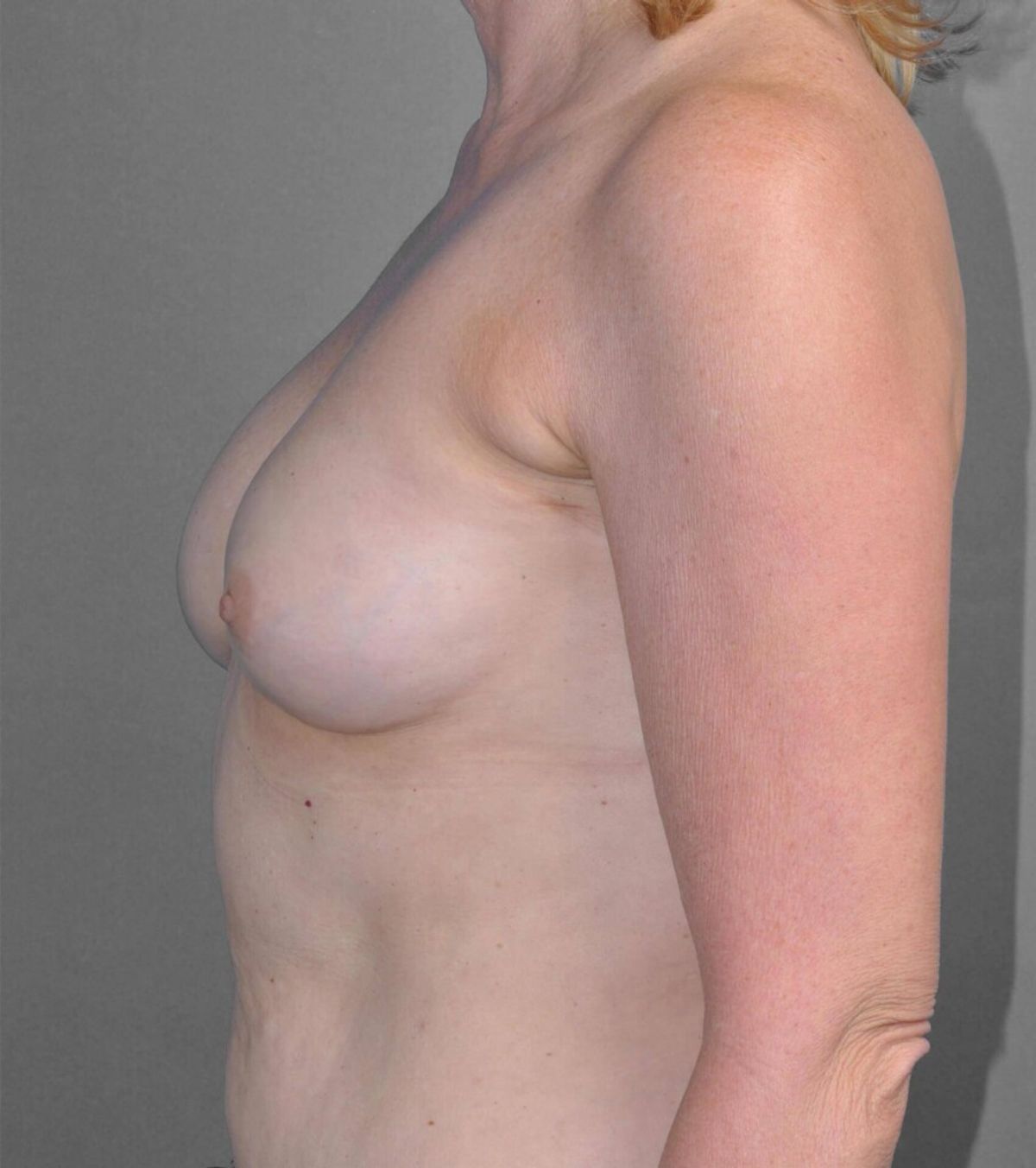 Case 1386 — Oblique before