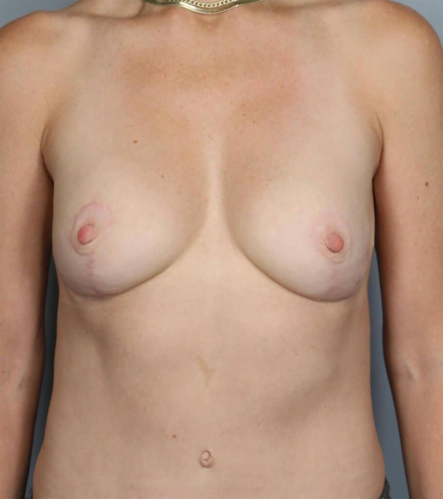 After — Fat Transfer Breast Augmentation