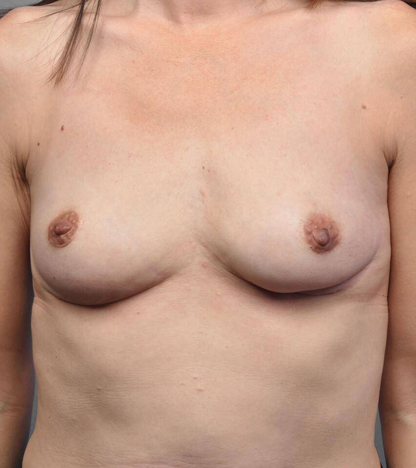After — Fat Transfer Breast Augmentation