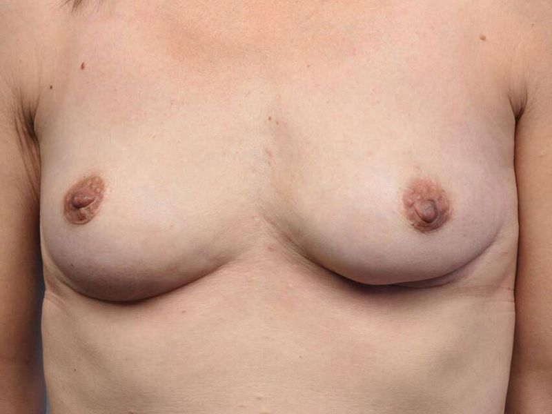 After — Breast Implant Removal (Explant)