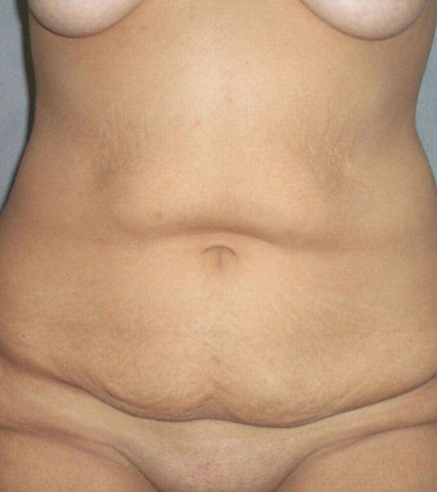 Before — Tummy Tuck