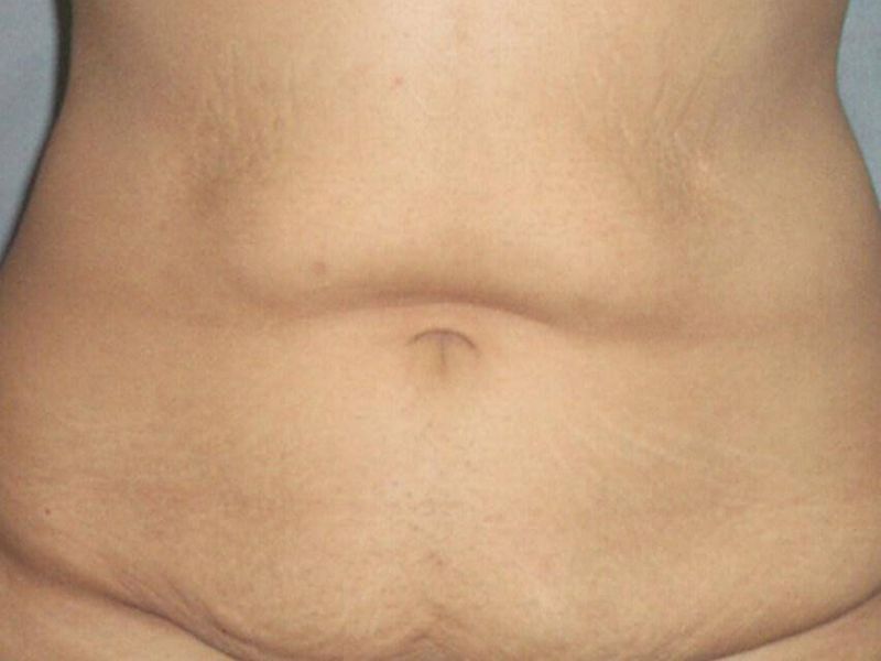 Before — Tummy Tuck
