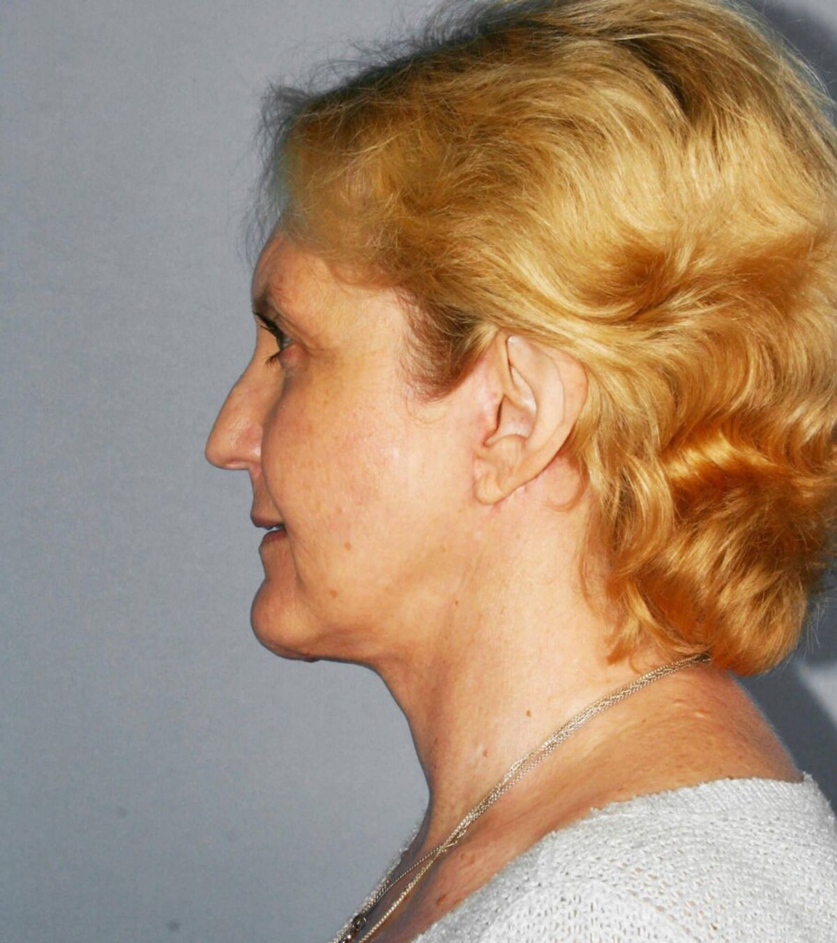 Case 1781 — Oblique after