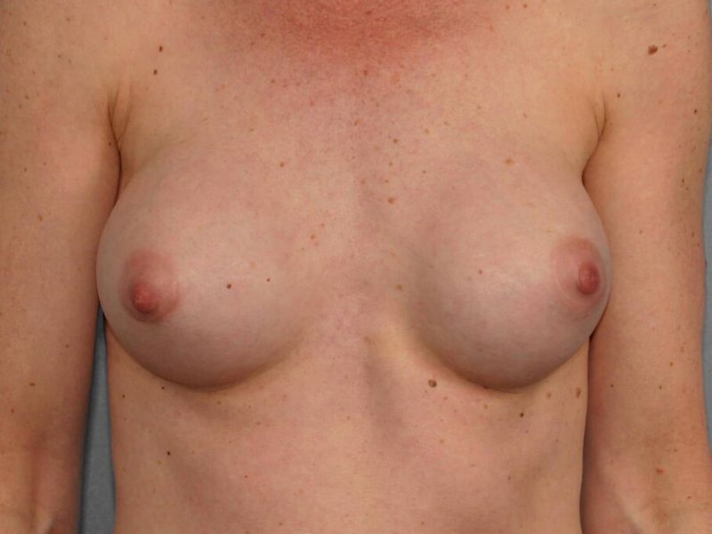 Before — Breast Implant Replacement
