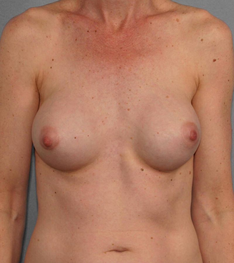 Before — Breast Implant Replacement