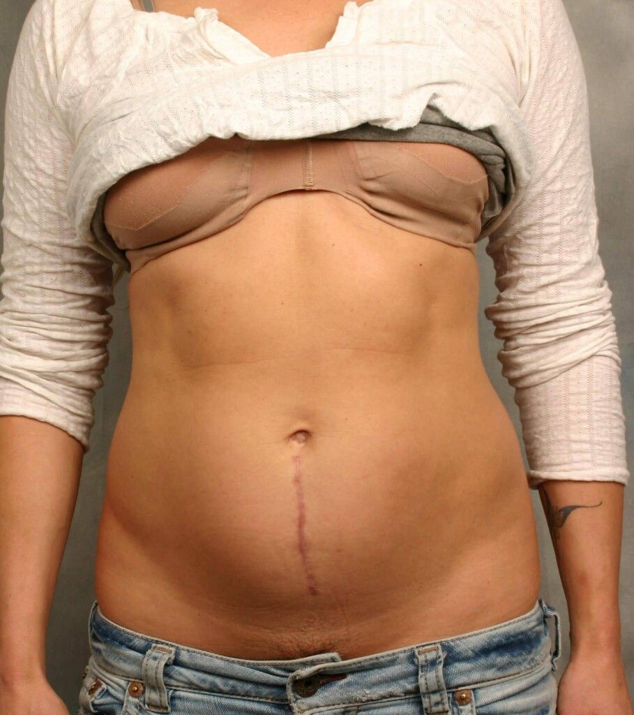 Before — Liposuction