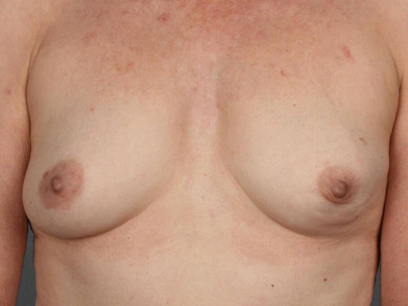 Before — Fat Grafting Breast Reconstruction