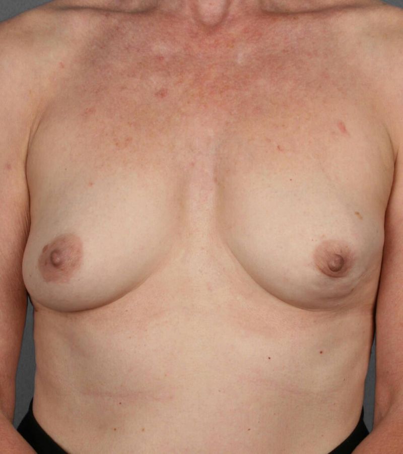 Before — Fat Grafting Breast Reconstruction