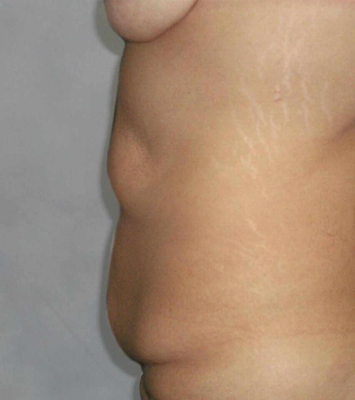 Case 1690 — Oblique before