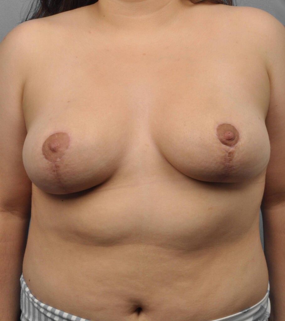 After — Breast Reduction