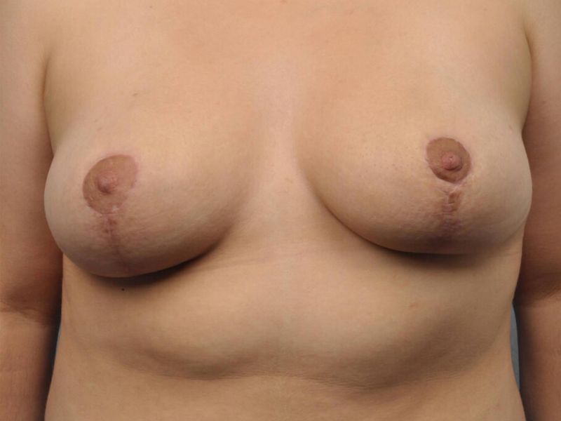 After — Breast Reduction