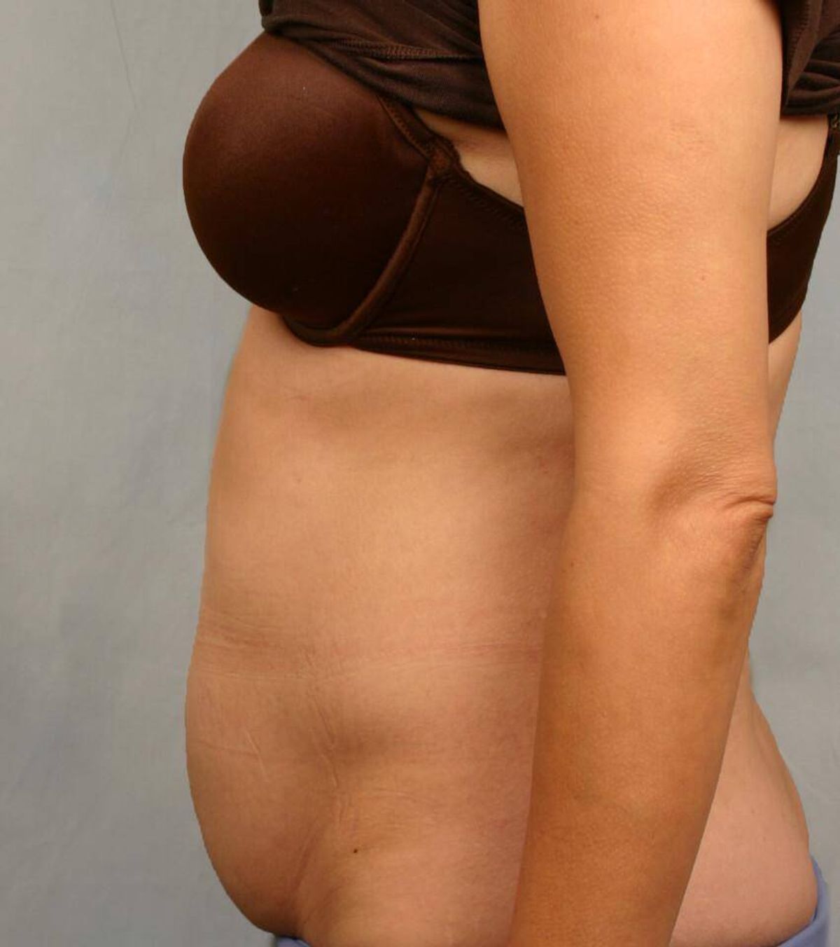 Case 1671 — Oblique before