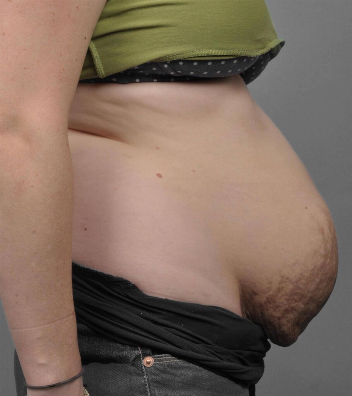 Case 1701 — Oblique before