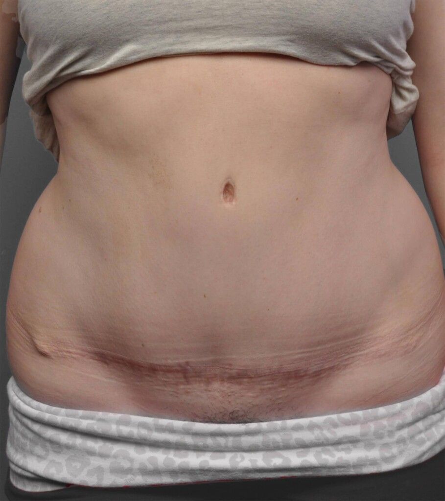 Mommy makeover after photo, tummy tuck with diastasis repair, Santa Monica patient, case 1701