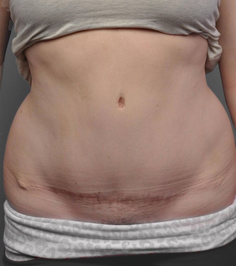 After — Tummy Tuck