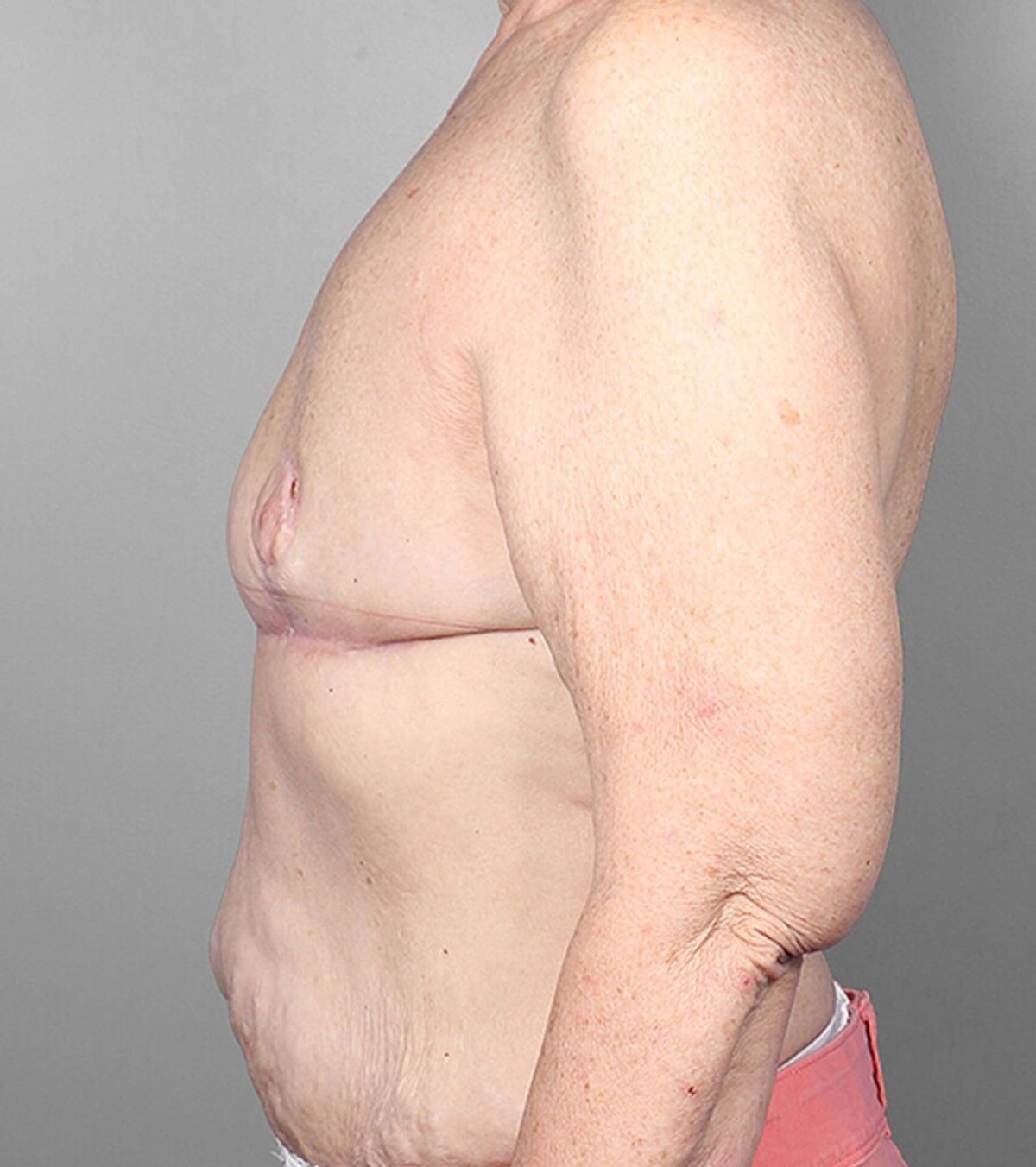 Case 1388 — Oblique after