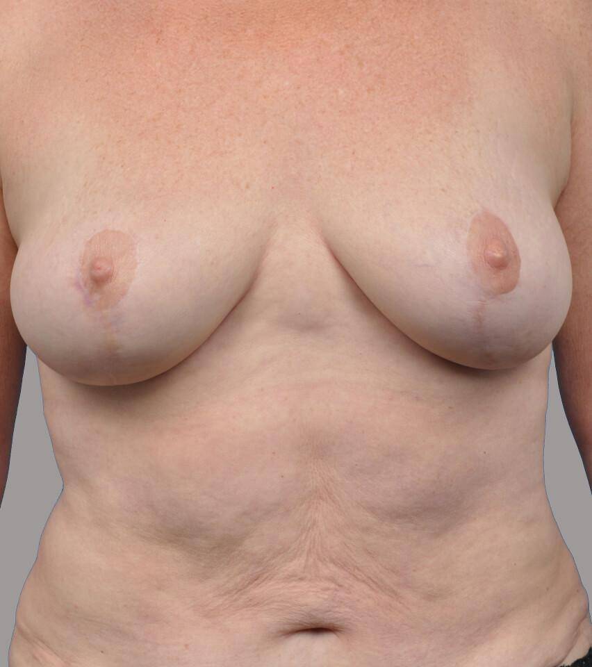 After — Breast Lift