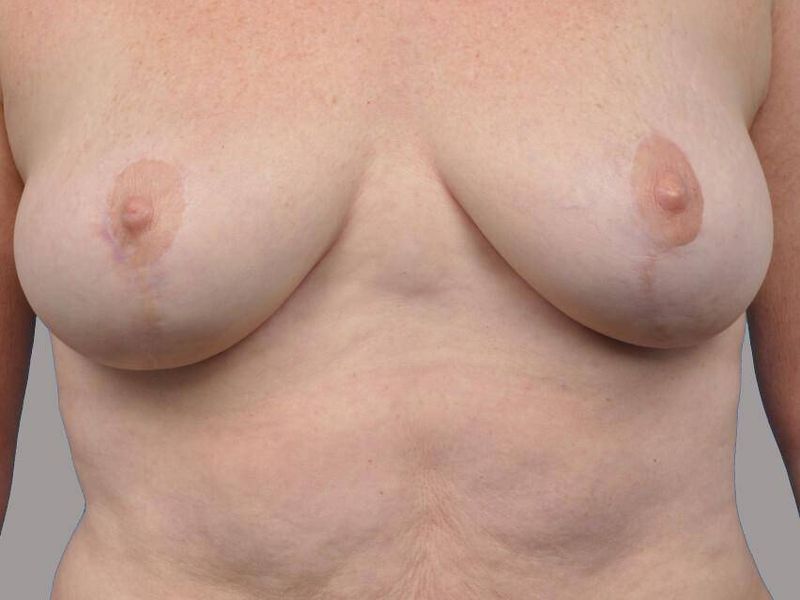 After — Breast Lift