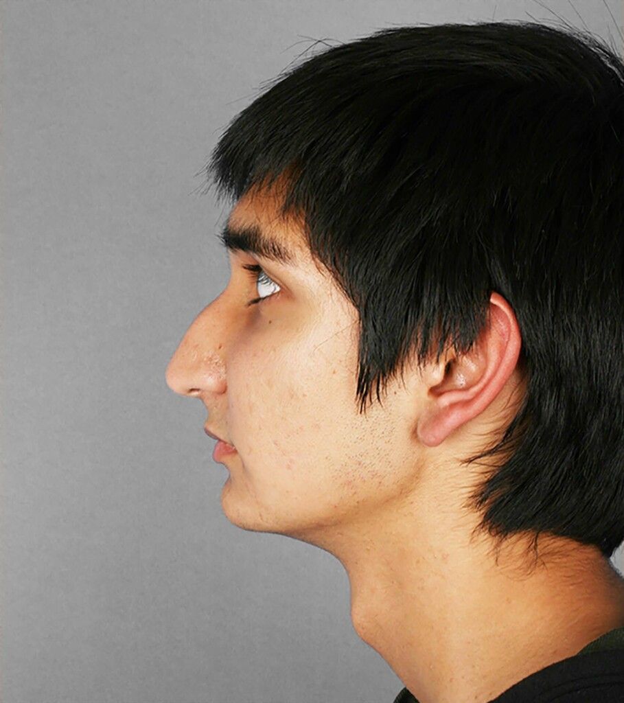 Before — Rhinoplasty