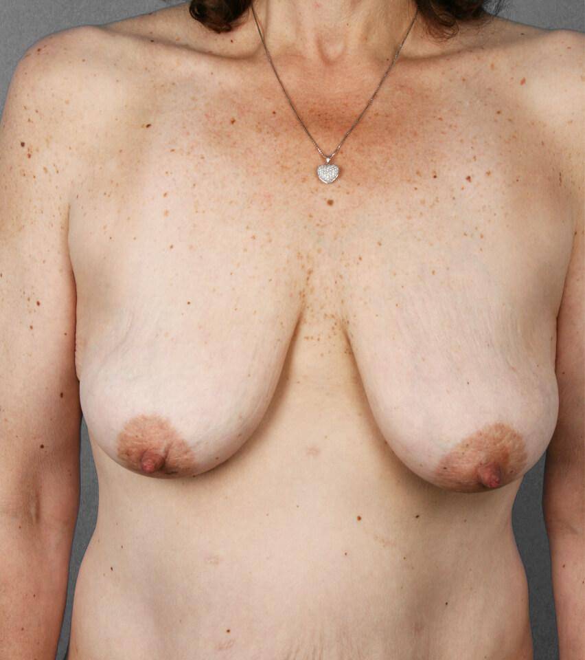 Before — Breast Lift