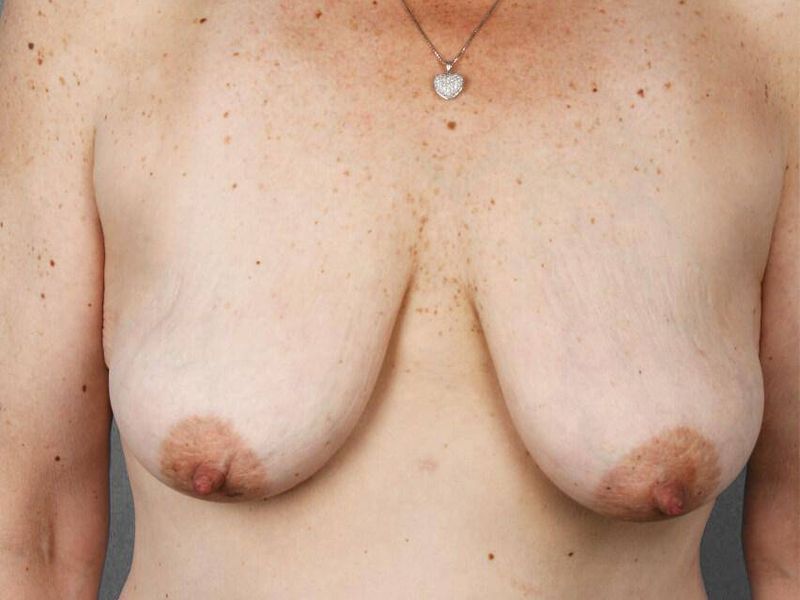 Before — Breast Lift