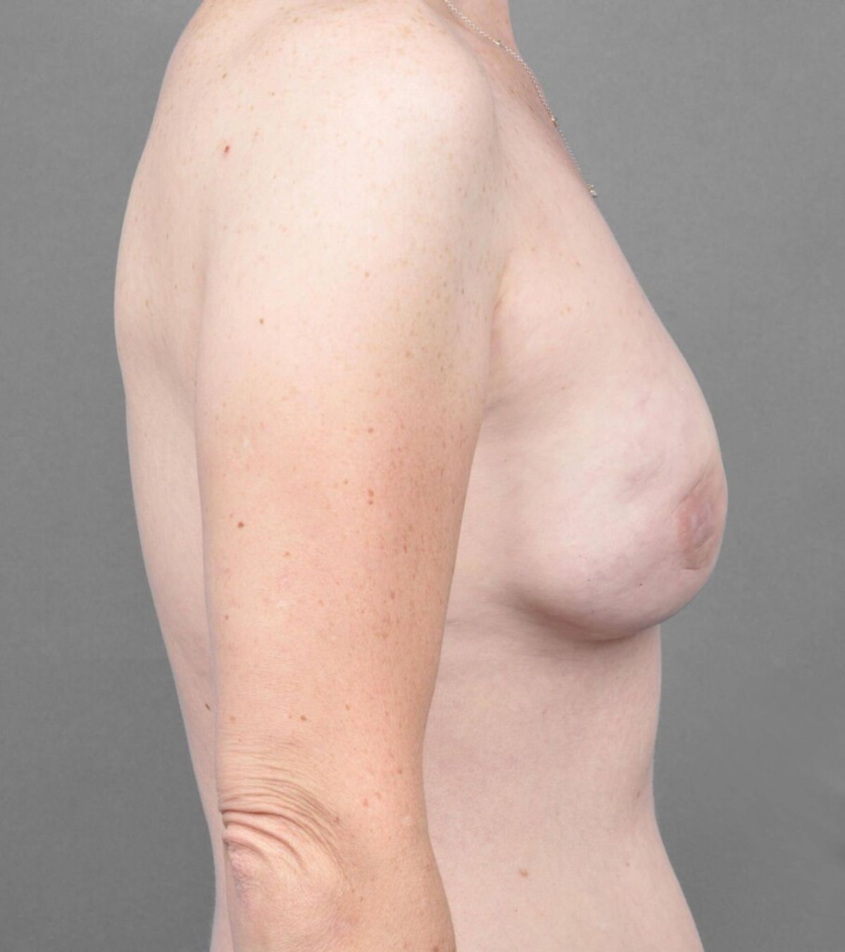 Case 1265 — Oblique after