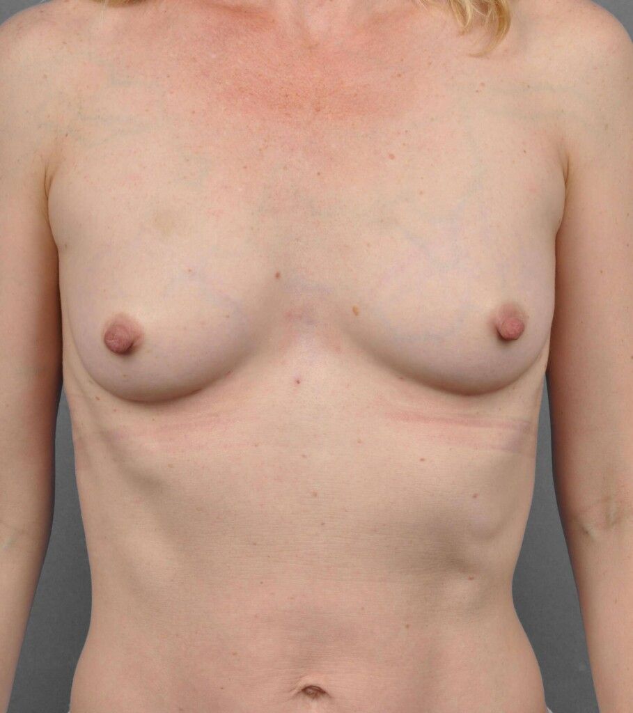 After — Fat Transfer Breast Augmentation