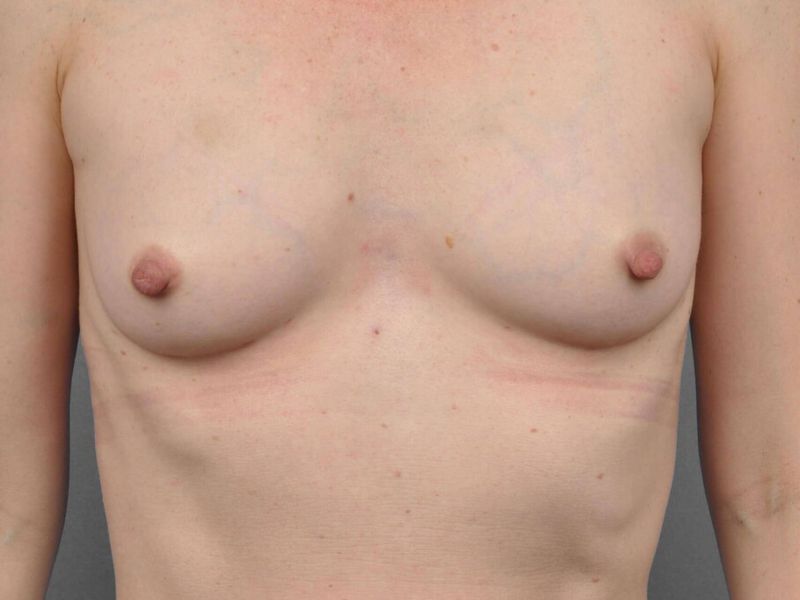 After — Fat Transfer Breast Augmentation