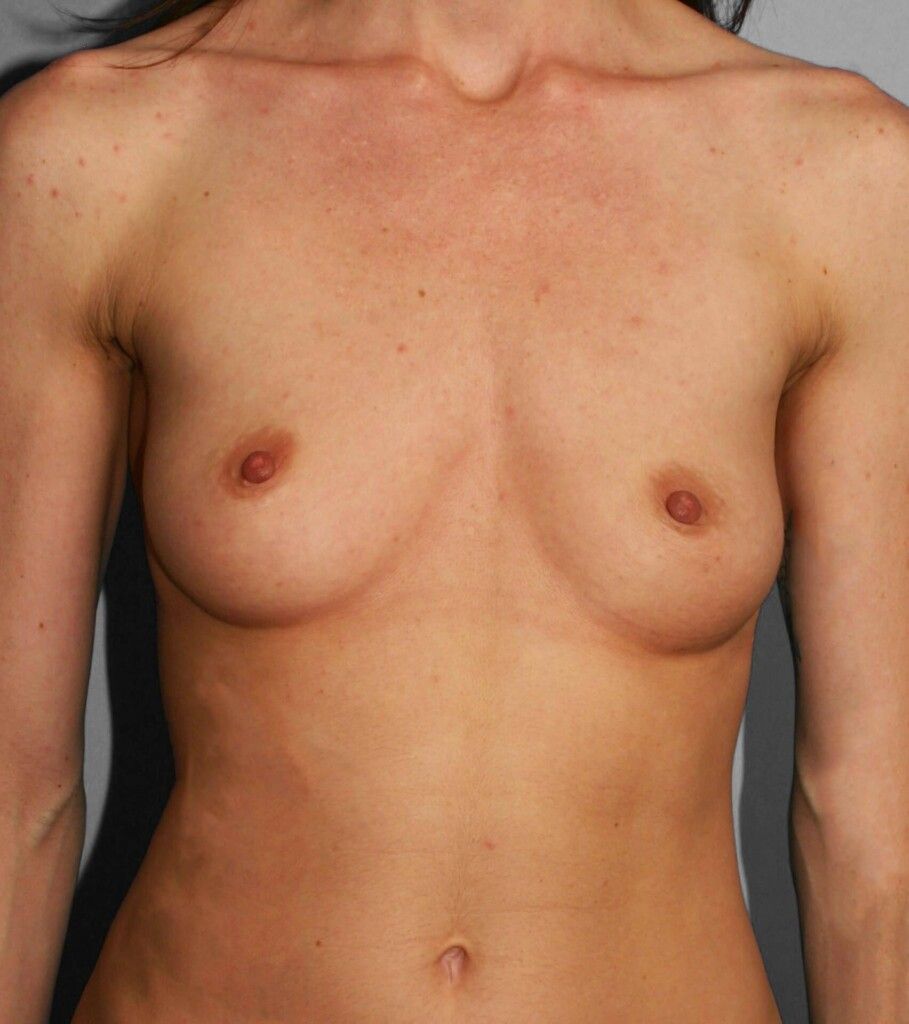 Before — Breast Augmentation