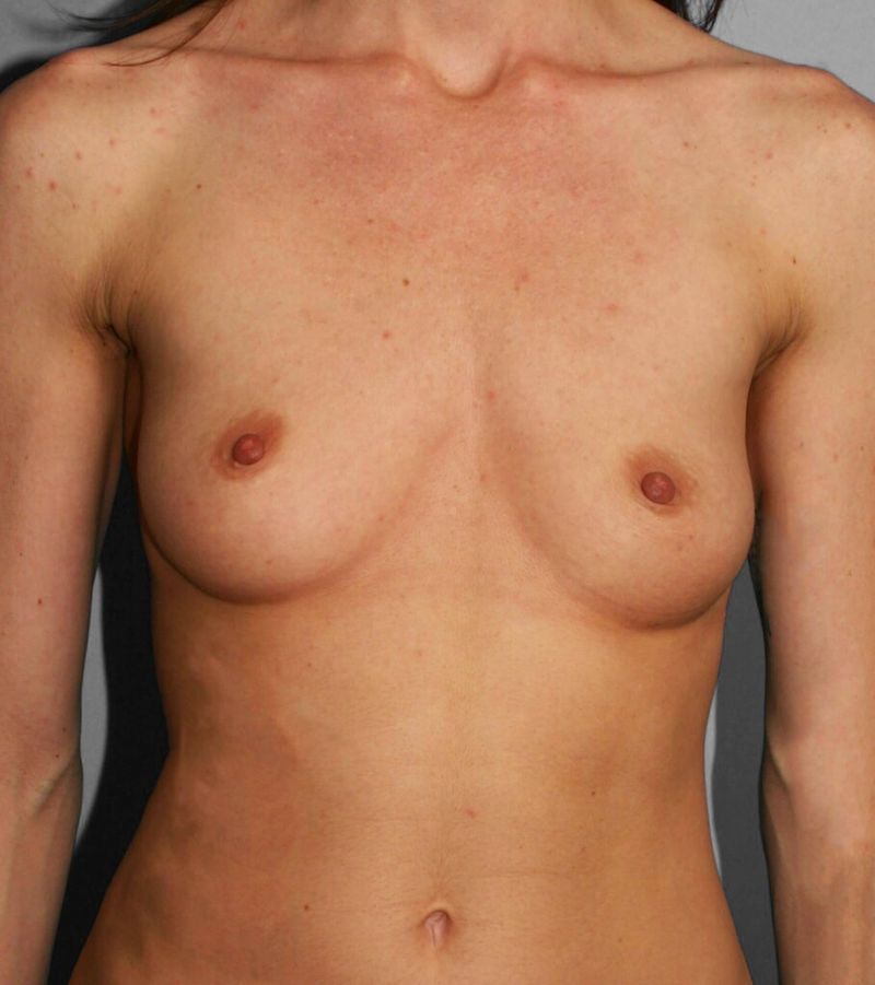 Before — Breast Augmentation