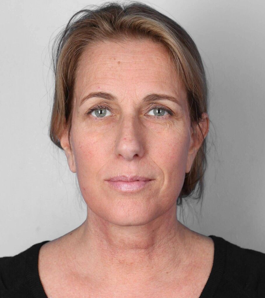 After — Facelift