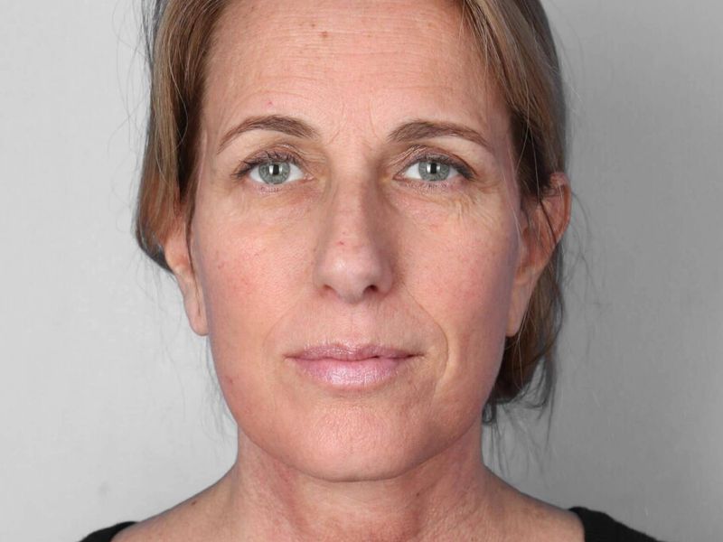 After — Facelift