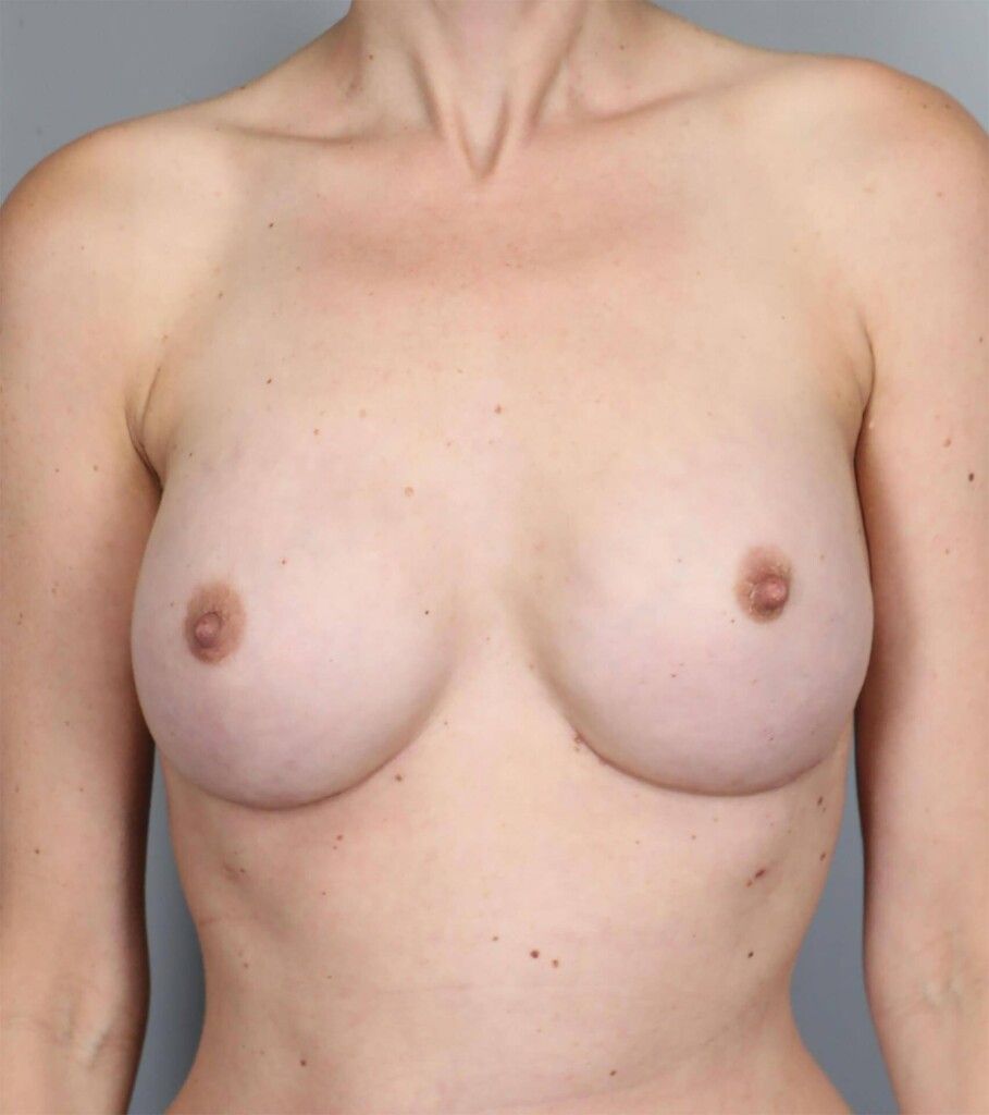 After — Direct-to-Implant Reconstruction
