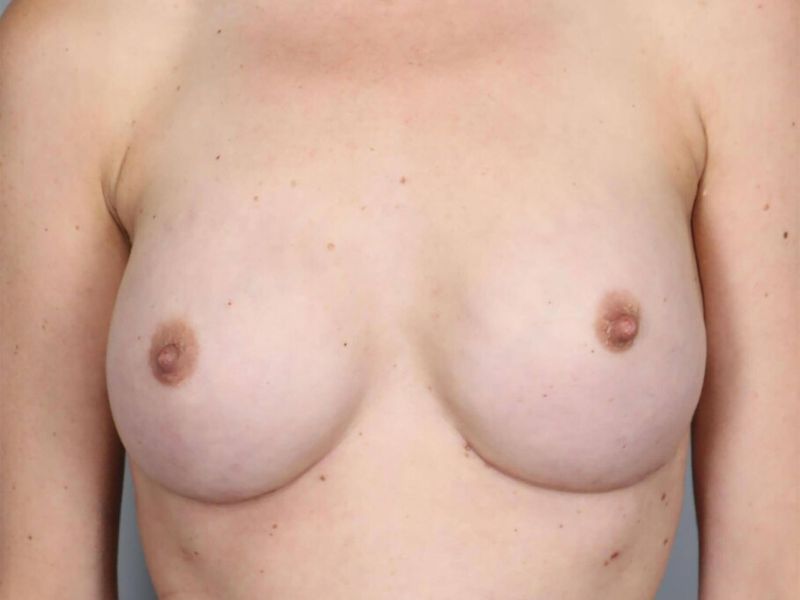 After — Direct-to-Implant Reconstruction