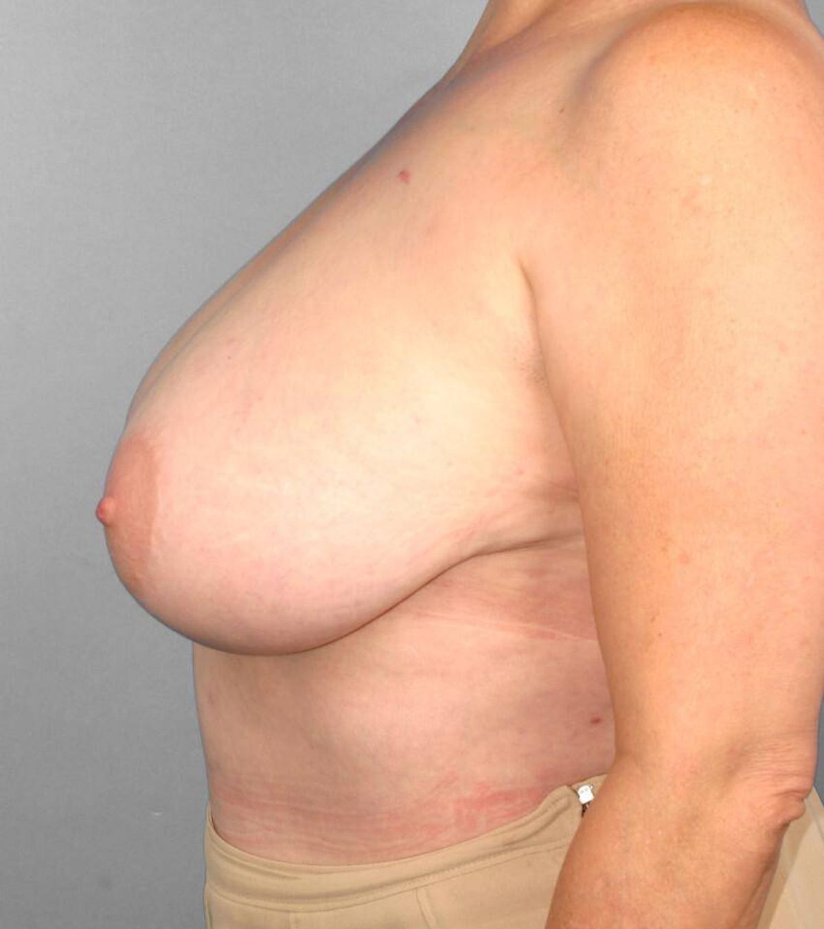 Case 1519 — Oblique before