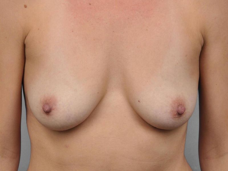 Before — Breast Augmentation