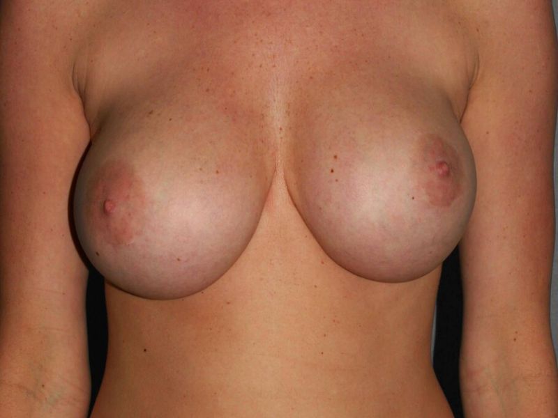 Before — Breast Implant Replacement