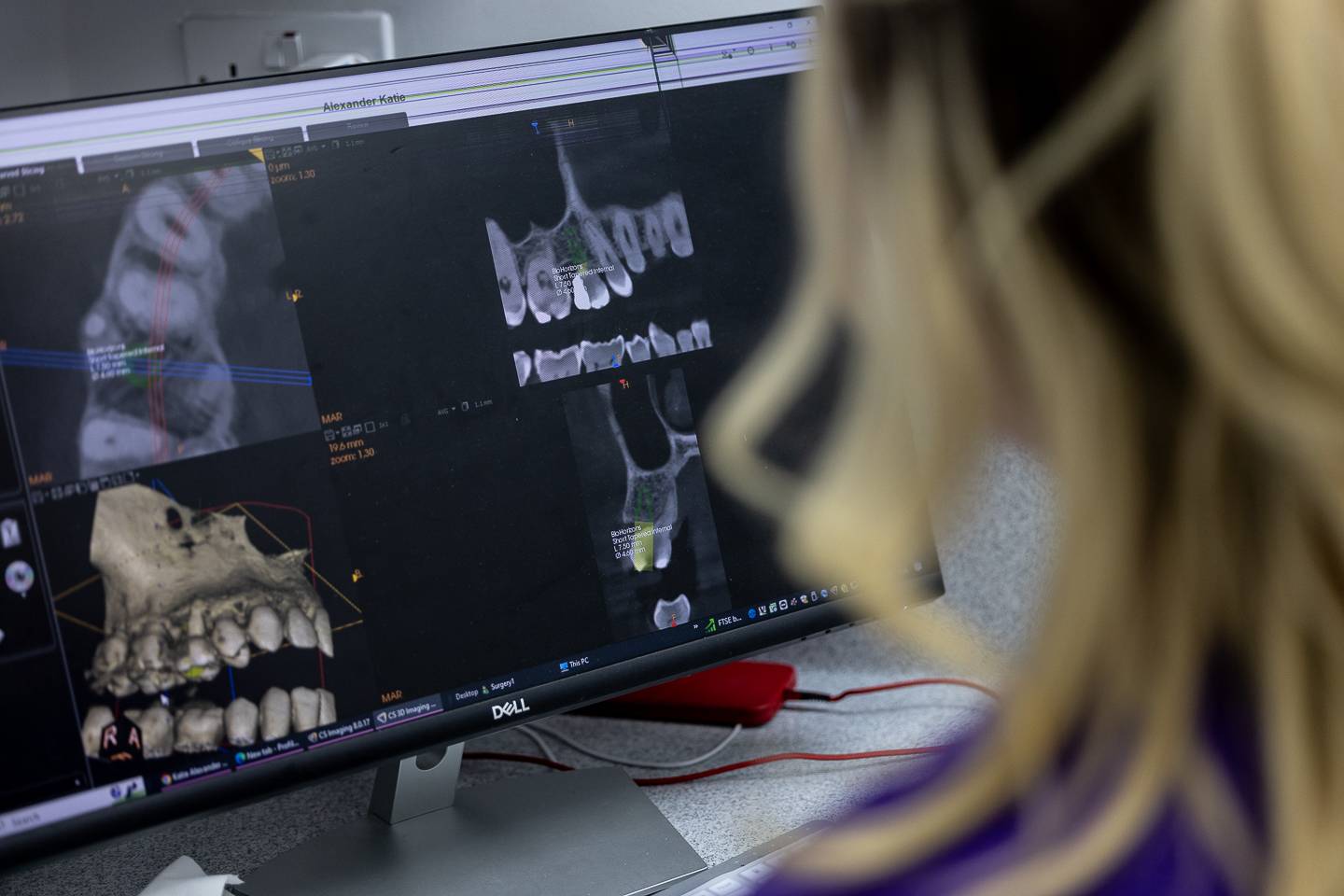 X-rays of dental patient's teeth