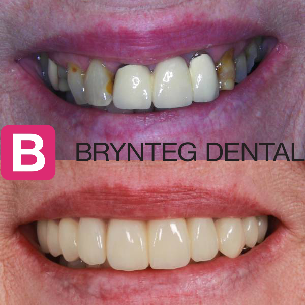 Before and after dental crown treatment
