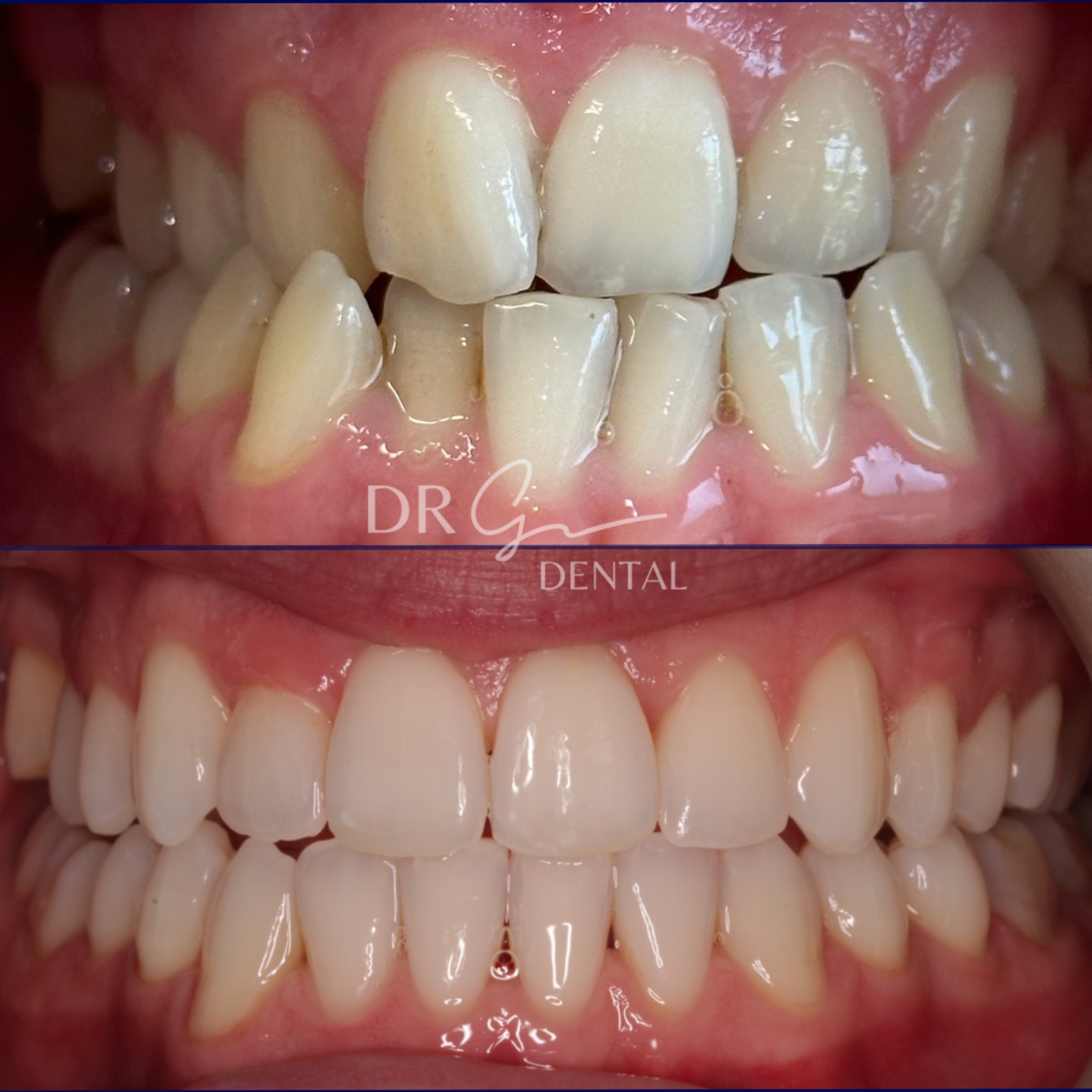 Invisalign before & after by Guto Griffiths
