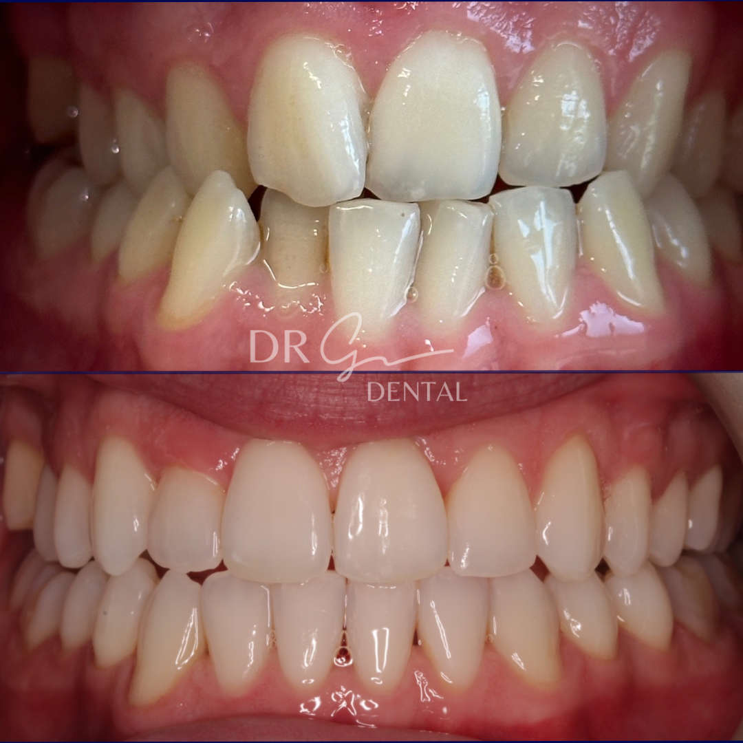 Invisalign before & after by Guto Griffiths