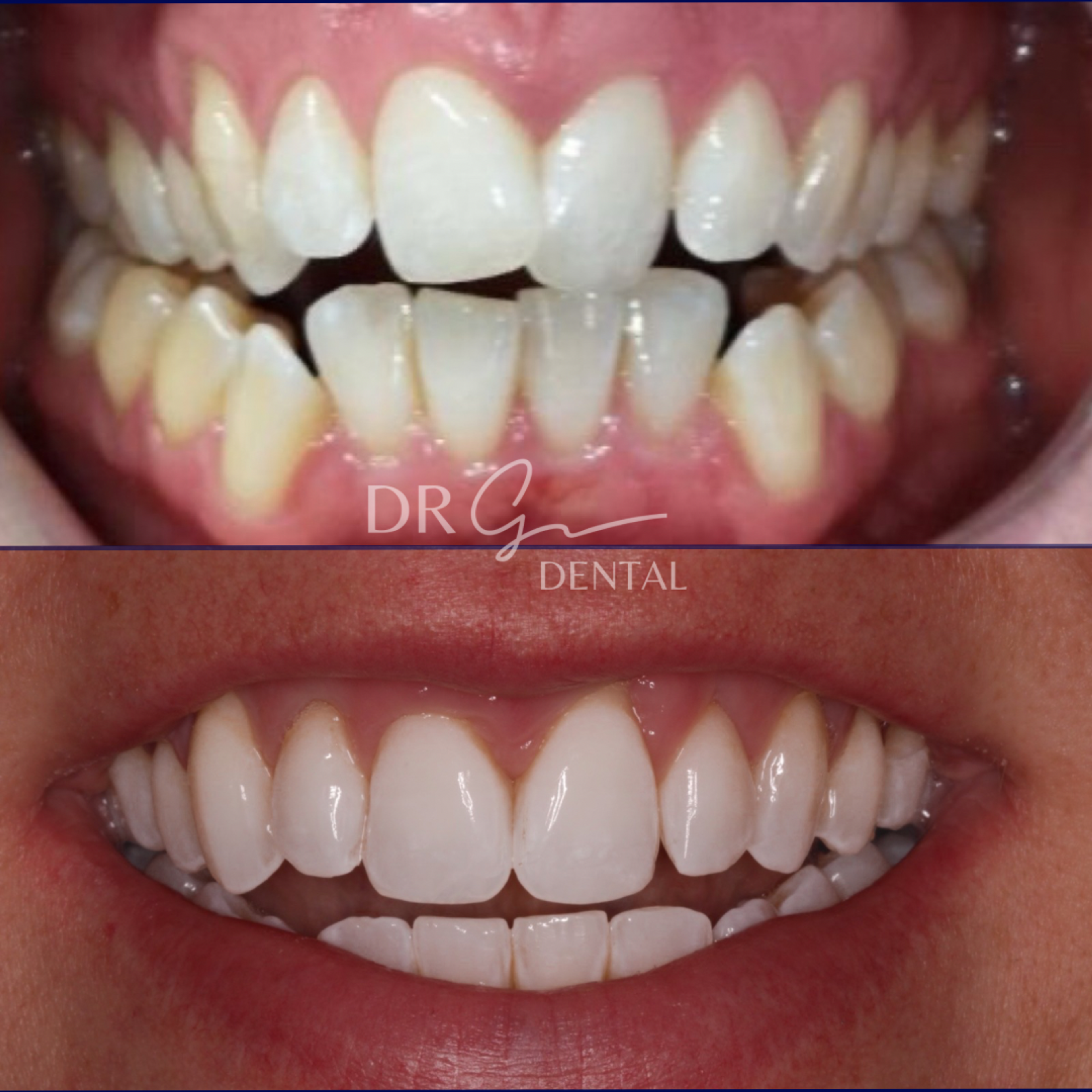 Before and after Invisalign straightening treatment