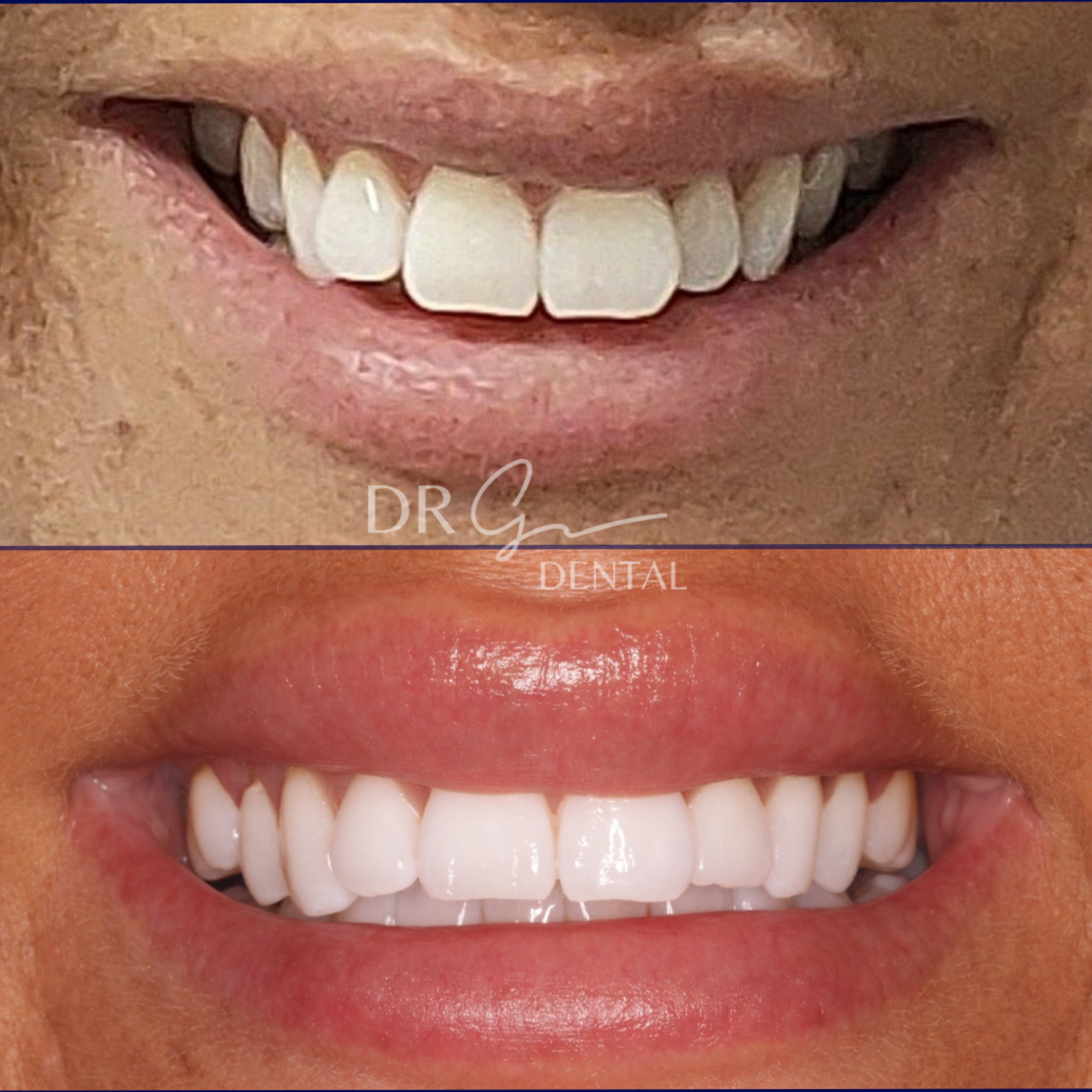 before and after Invisalign and whitening treatment
