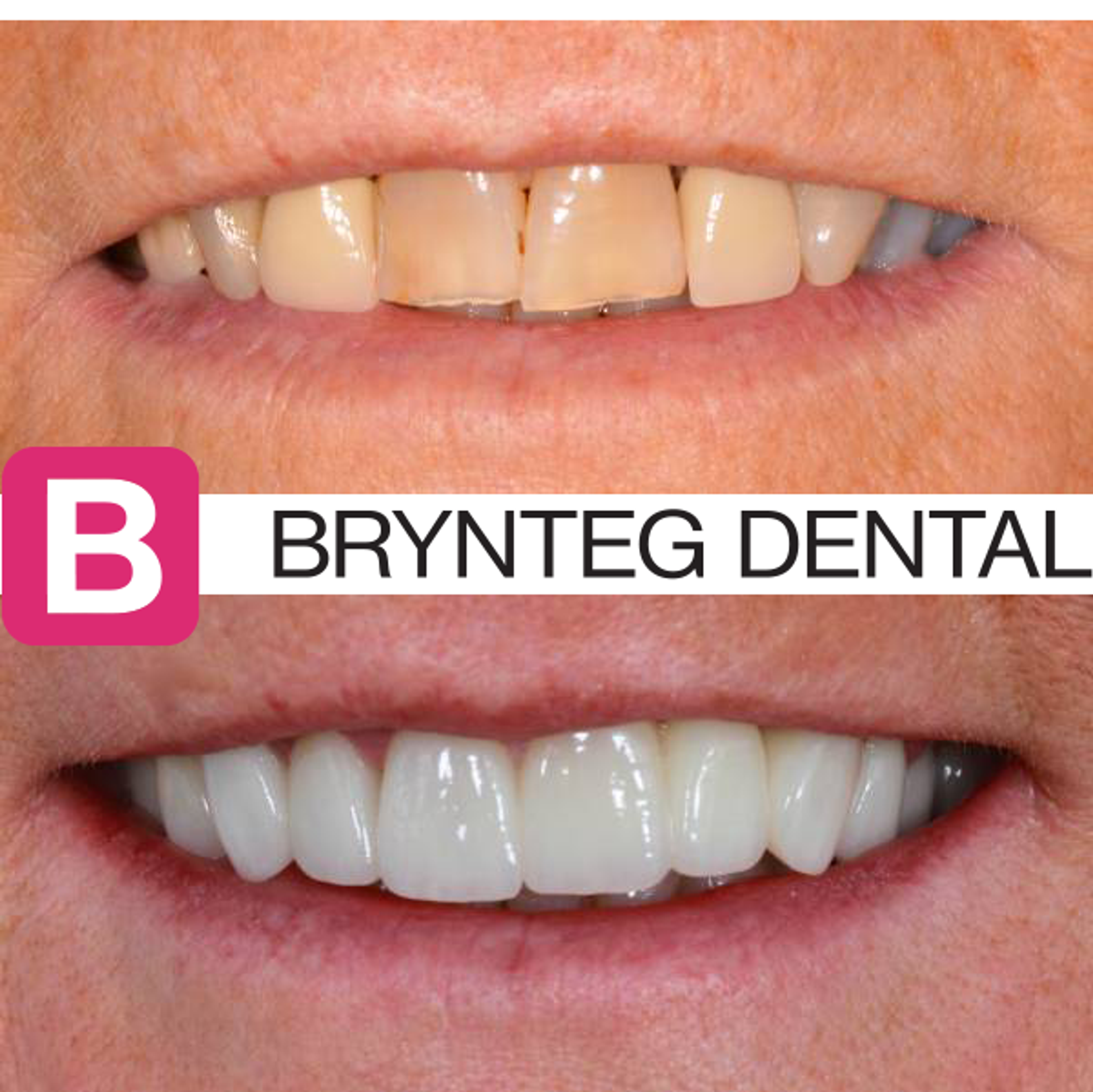 Before and after dental crown treatment